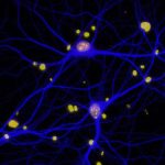 Perdita dell’olfatto prima dei 65 anni? Attenzione: potrebbe essere il segnale dell’Alzheimer precoce