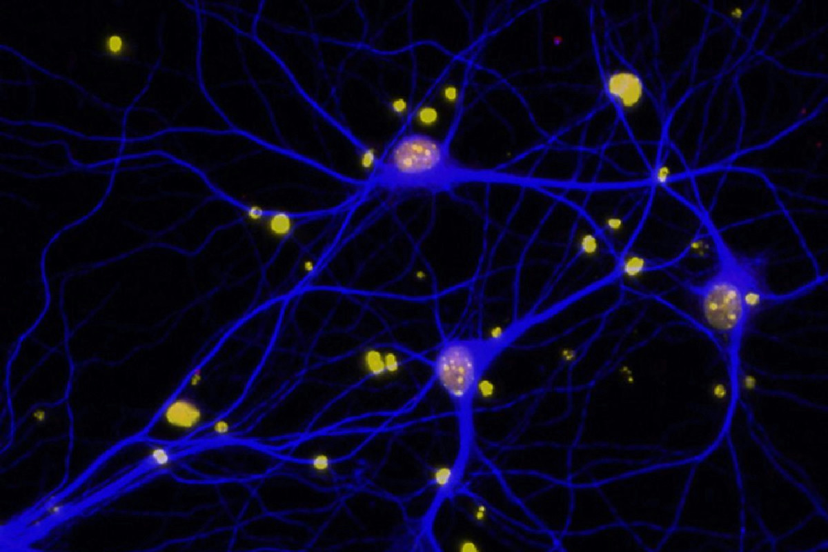 Perdita dell’olfatto prima dei 65 anni? Attenzione: potrebbe essere il segnale dell’Alzheimer precoce